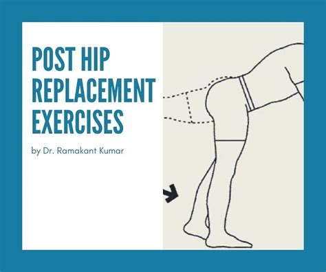 Posterior Hip Replacement Exercises