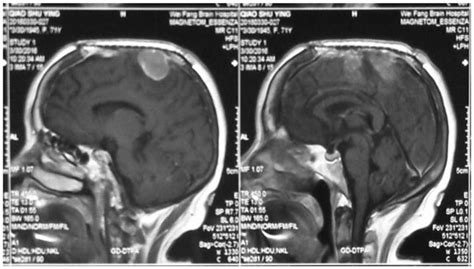 The recurrence of meningioma after surgery. | Download Scientific Diagram