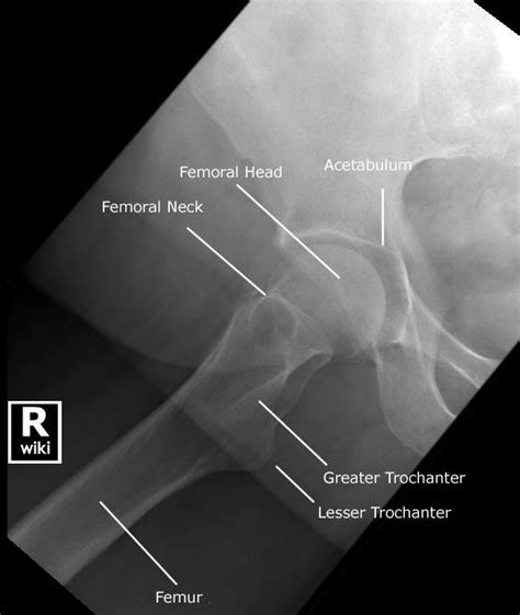 Hip Radiographic Anatomy - wikiRadiography | Radiology schools ...