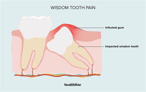 Wisdom Tooth Abscess