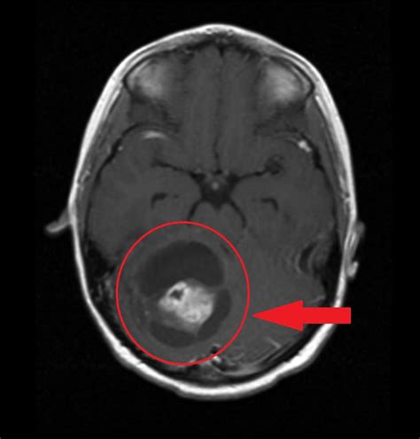 Astrocytoma MRI - wikidoc