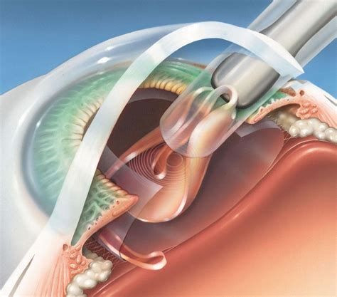 Day of Cataract Surgery - Eye Care Ltd - Ophthalmologists, Eye Surgeons