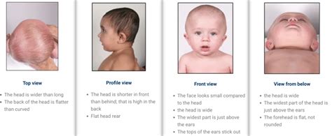 Difference between plagiocephaly and brachycephaly