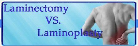 Laminectomy VS Laminoplasty Which one is best for me