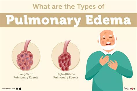 Pulmonary Edema - Symptom, Causes, Treatment And Prevention