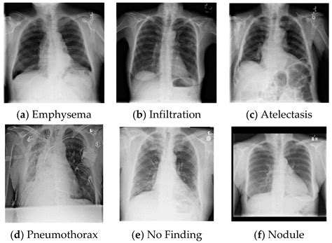 Healthy Lungs Vs Smokers Lungs X Ray