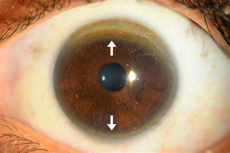 Anterior segment optical coherence tomography to look for Kayser ...