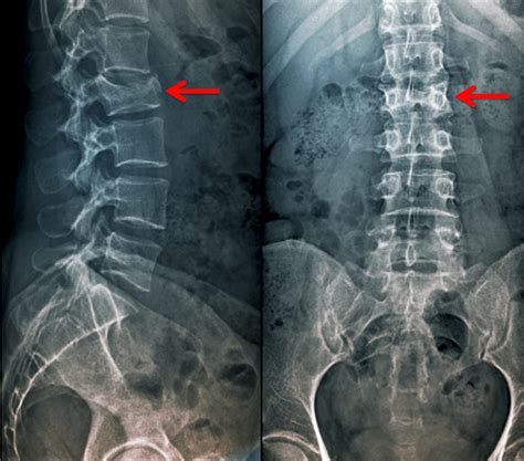 Symptoms Thoracic Wedge Fracture | Easy Health Care Solution ...