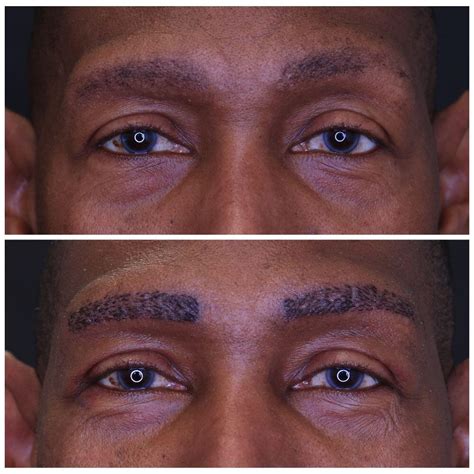 Collection 93+ Pictures Eyebrow Transplant Before And After Photos Sharp