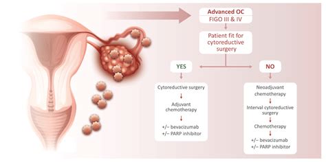 Reprod. Med. | Free Full-Text | Ovarian Cancer: Treatment and ...