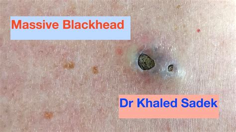 Massive 3 year old Blackhead finally comes out. Dr Khaled Sadek ...