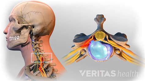 Cervical Herniated Disc | englishfor2day.com