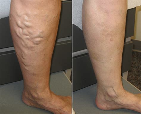 Varicose veins treatment in Clark - Daily Nutrition News