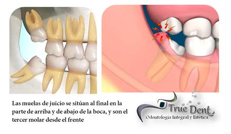 TRUEDENT: Cuando extraer las muelas del juicio?