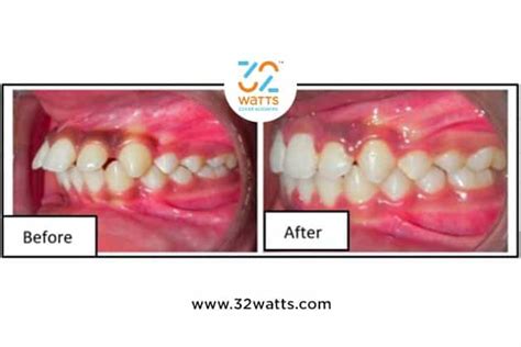 Clear Aligners Before And After In India