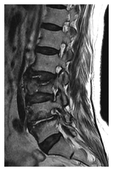 Preoperative MRI and X-ray show a L3 compression fracture with ...