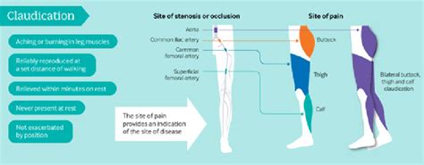 Intermittent claudication (IC) due to peripheral arterial disease ...