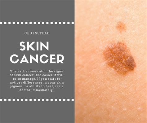 Symptoms of Skin Cancer – CBD Instead