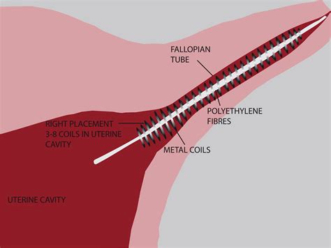 Hysteroscopic tubal sterilization: a systematic review of the Essure ...