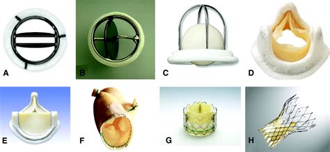 Prosthetic Heart Valves | Circulation