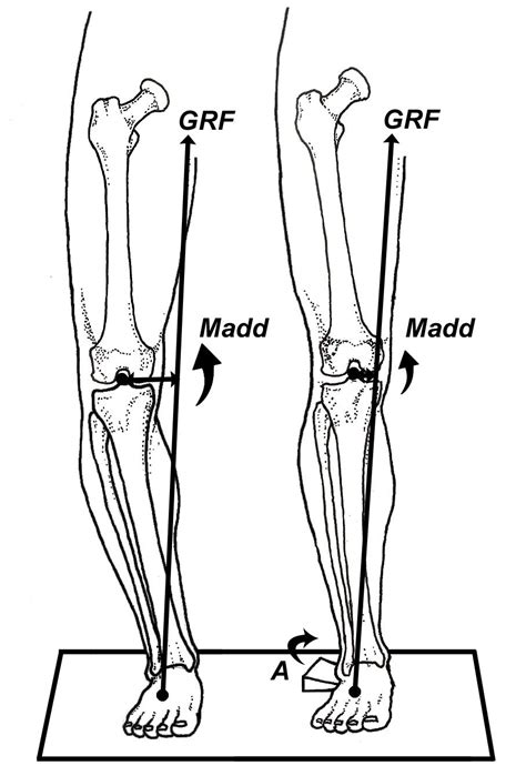 Valgus Vs Varus Of Ankle