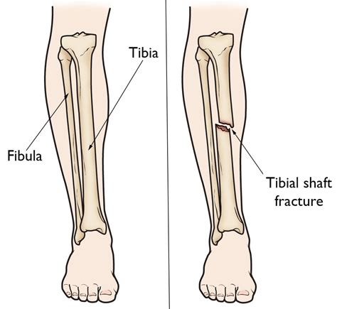 Tibia Fibula Anatomy - Anatomy Reading Source