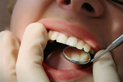 What is Dental Debridement? - Konig Center for Cosmetic & Comprehensive ...