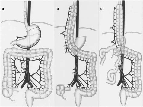 Esophageal Cancer | Oncohema Key