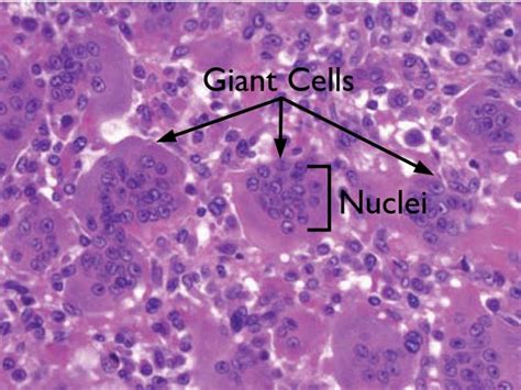 Giant Cell Tumor of Bone - OrthoInfo - AAOS