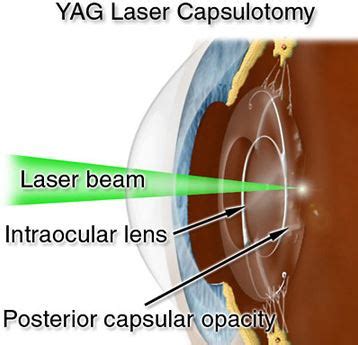 YAG Laser Capsulotomy - NewView Eye Center - NewView Eye Center