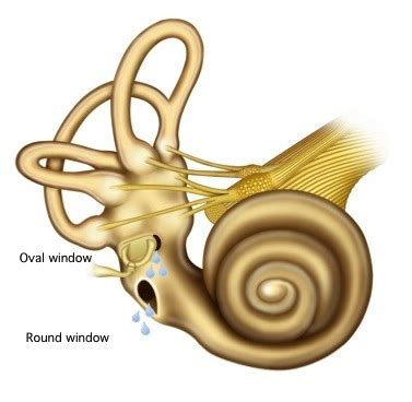 Perilymph fistula (PLF) - Louis Hofmeyr