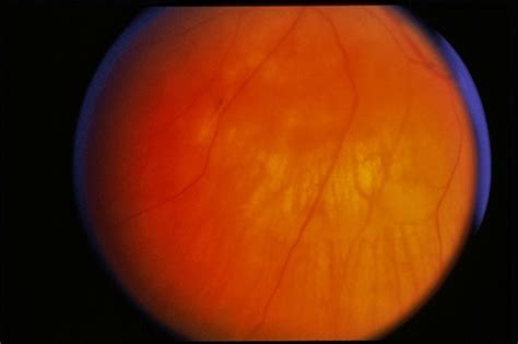 Choroidal Hemangioma / RD - Retina Image Bank