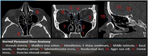 Figure 2 from Functional endoscopic sinus surgery (FESS): what ...