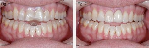 Diagnosing and Treating Anterior Open Bites - Spear Education