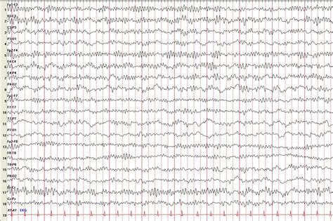 EEG | Somatosphere