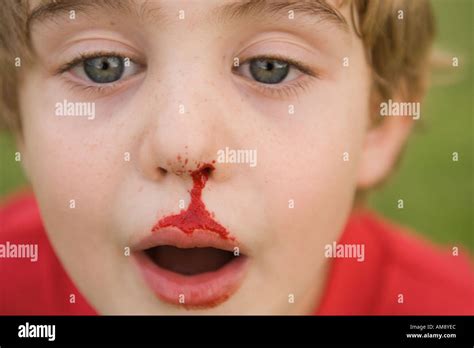 boy with bleeding nose Stock Photo: 4959211 - Alamy