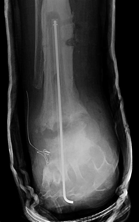 arthrodesis | The Foot and Ankle Online Journal