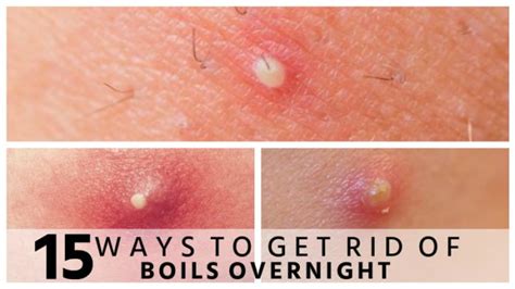 Best Effective Natural Home Remedies For Boils (skin Abscesses)