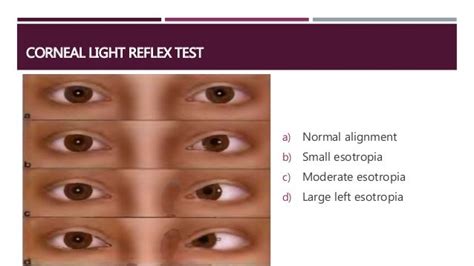 Pediatric Eye Examination