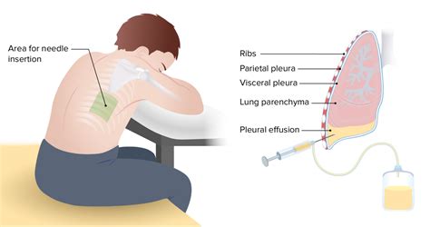 Pleural Effusion | Concise Medical Knowledge