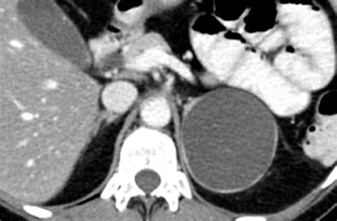 The Radiology Assistant : Characterization of Adrenal lesions