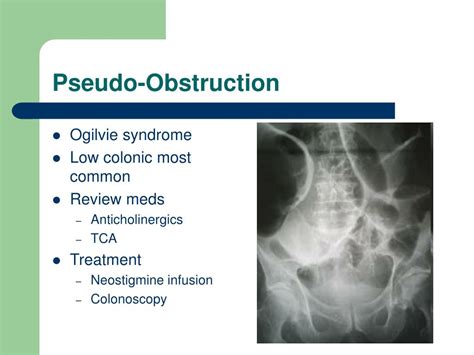 PPT - Intestinal Obstruction PowerPoint Presentation, free download ...