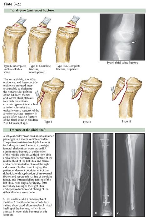 TIBIAL INTERCONDYLAR EMINENCE FRACTURE | Fracture healing, Hamstring ...