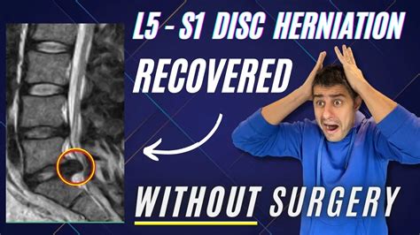 L4 L5 - L5 S1 disc herniation recovered pain free without surgery