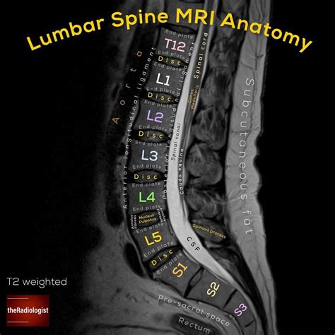 Sagittal T2 weighted image of an MRI of the lumbar spine ⁣ ⁣ LUMBAR ...