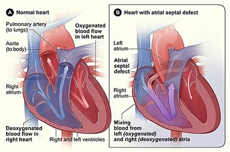 What is Congenital Heart Disease - Types, Causes, and Symptoms