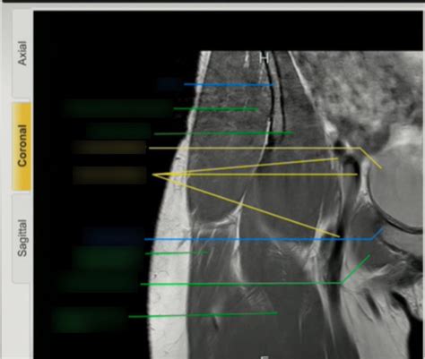 Coronal Hip MRI 1 Diagram | Quizlet