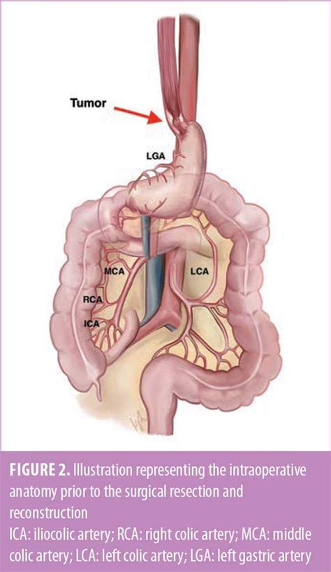 Colonic Interposition Graft as a Conduit following Esophagectomy for ...