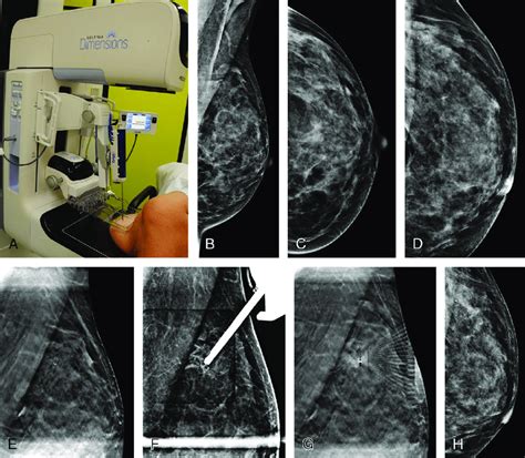 Digital breast tomosynthesis-guided biopsy. A 49-year-old patient with ...