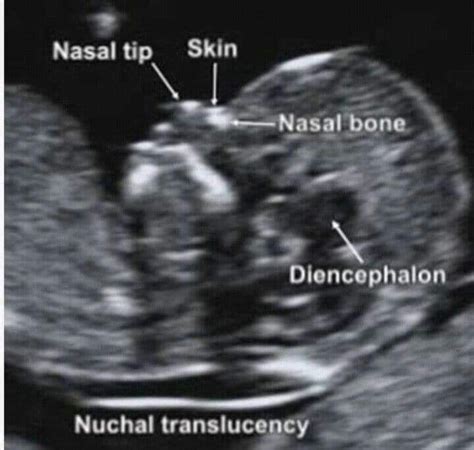 Nuchal Translucency Chart Measurements